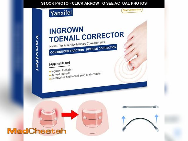 Lot 74-14270592 - Nitinol Ingrown Toenail Corrector,at Home Ingrown Toenail Treatment,Curved Toenail Straightener,Ingr...